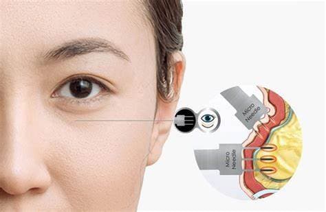 Say Goodbye to Eye Bags: Effective Treatments to Refresh Your Appearance
