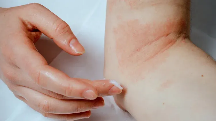 Understanding Atopic Dermatitis: Signs, Causes, and Treatments