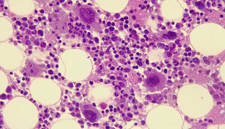 Triple-Negative Breast Cancer: 10 Warning Signs You Can’t Ignore!