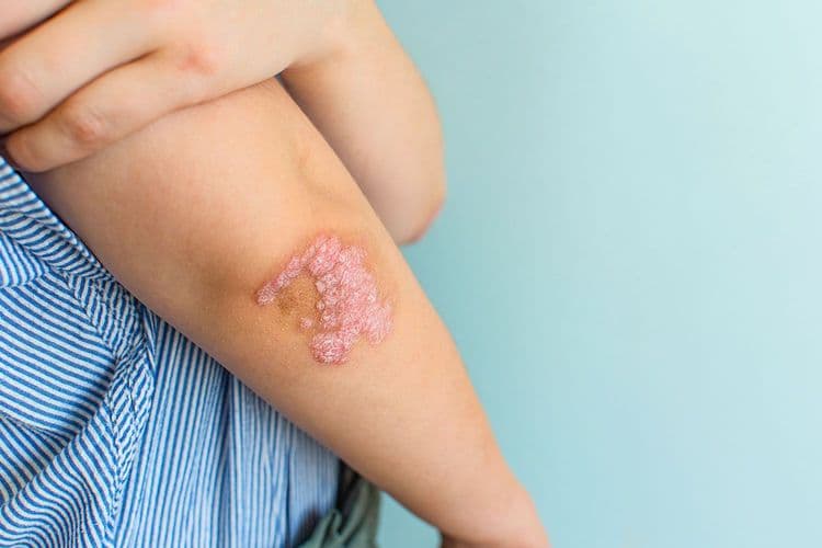 What Does Early Scalp Psoriasis Really Look Like?