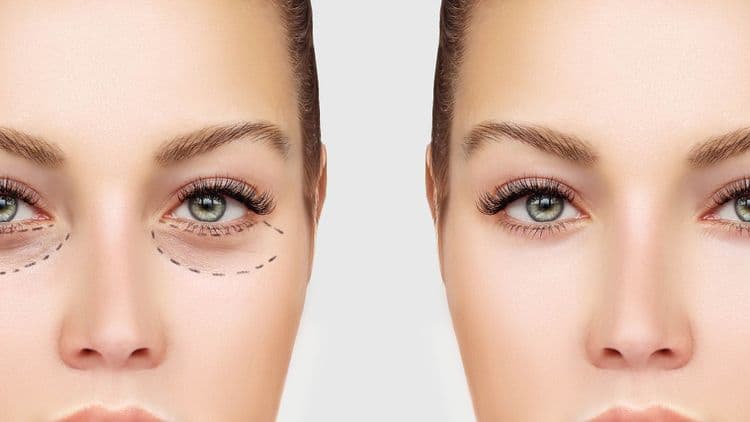 Why Juvéderm Is Catching Eyes for a Refreshed Look