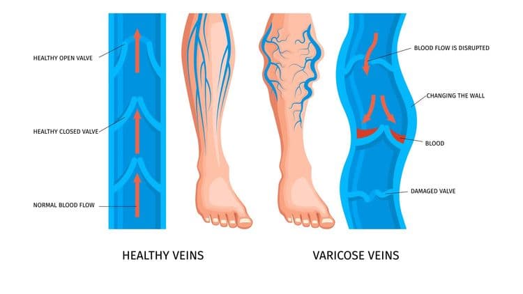The Latest Varicose Veins Treatments Doctors Are Recommending